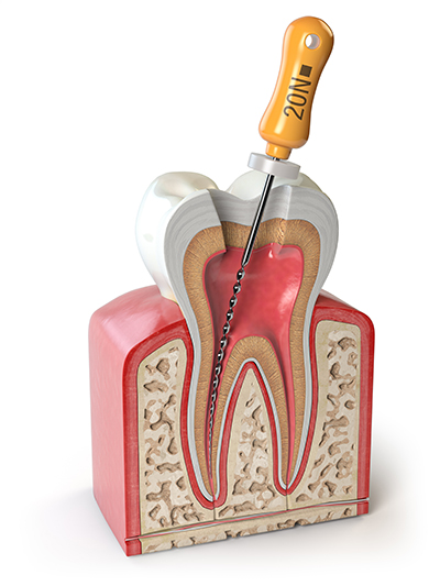 Dental Filling After a Root Canal - Casas Adobes Dentistry Tucson Arizona